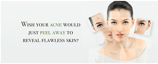 We--8217-ve-Got-The-Solution-To-Acne-Treatment