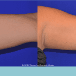 How-To-Get-Rid-Of-Those-Flabby-Arms