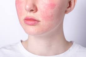 Person with sensitive, irritated skin showing redness and inflammation on the face.