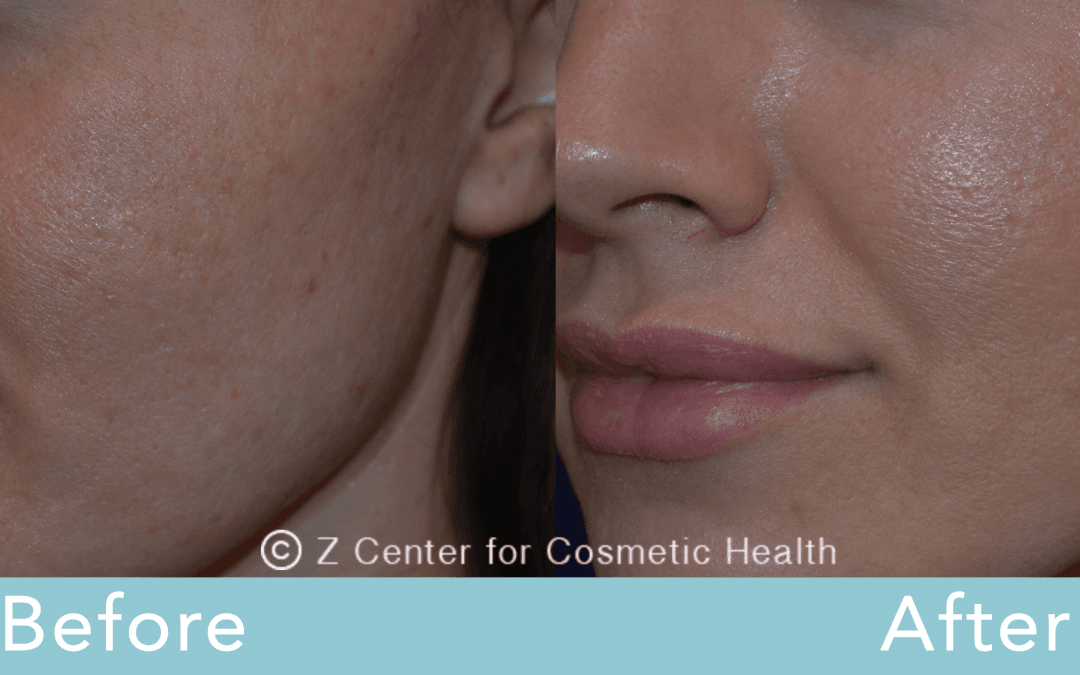 Acne Scars Treatments | Los Angeles
