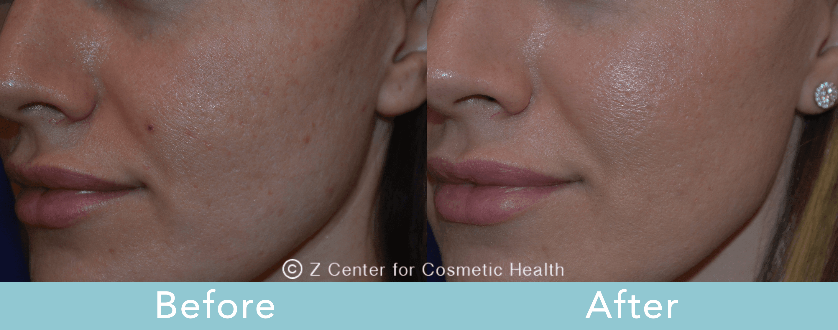 Acne-Scars-Treatments---Los-Angeles