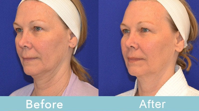 Skin Sagging Treatment: Battle Skin Sagging With Ultherapy