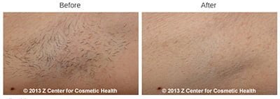 laser hair removal