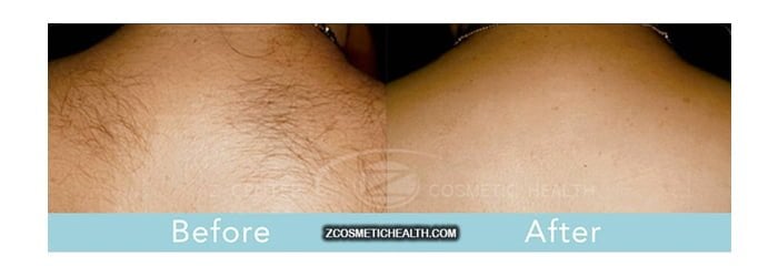 Laser Hair Removal: Worth Every Penny