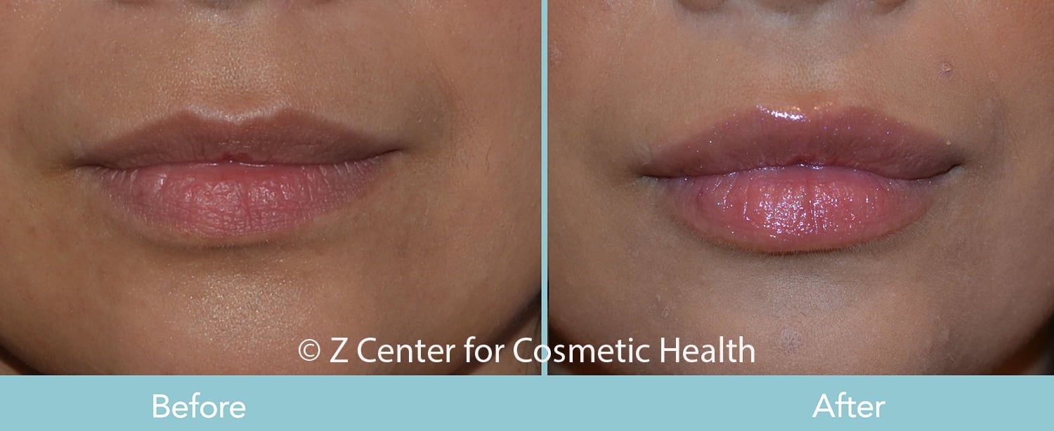 Patient--5128- plump and full lips