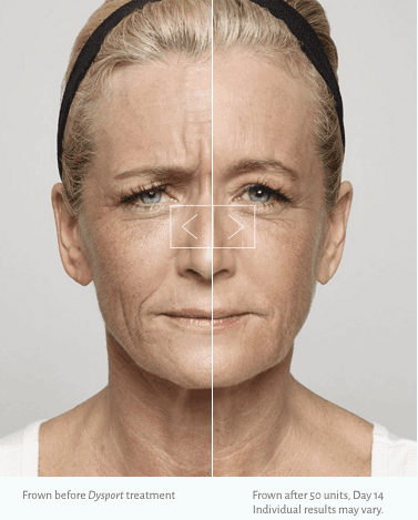 Improve Frown Lines without Changing the Rest of Your Face