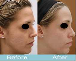 The Long List of Best Acne Treatments: Nano-Ray Laser Skin Resurfacing