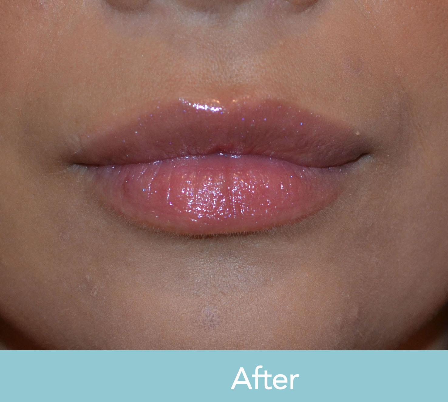 Considering-Lip-Fillers-in-Los-Angeles--Read-This-First