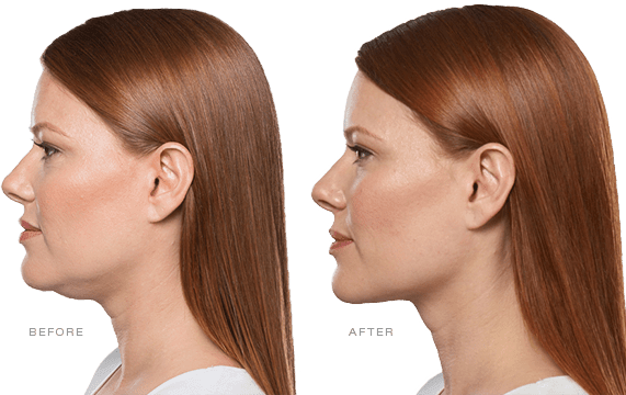 Look 10 Pounds Lighter With This Quick Non-Surgical Treatment
