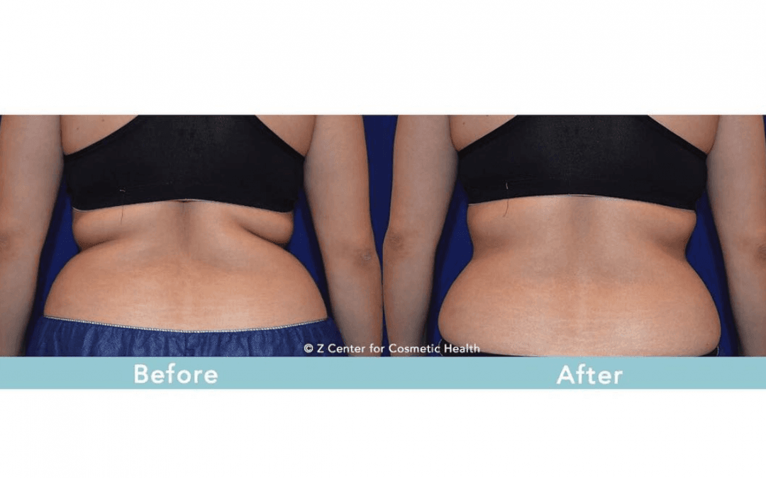 Top 3 Reasons to Get CoolSculpting Now