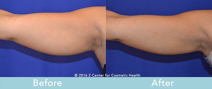 Emsculpt vs. CoolSculpting