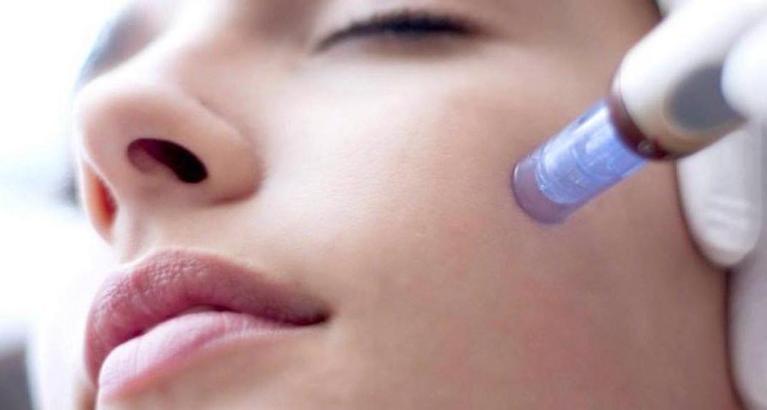 5 Surprising Microneedling Benefits for Skin
