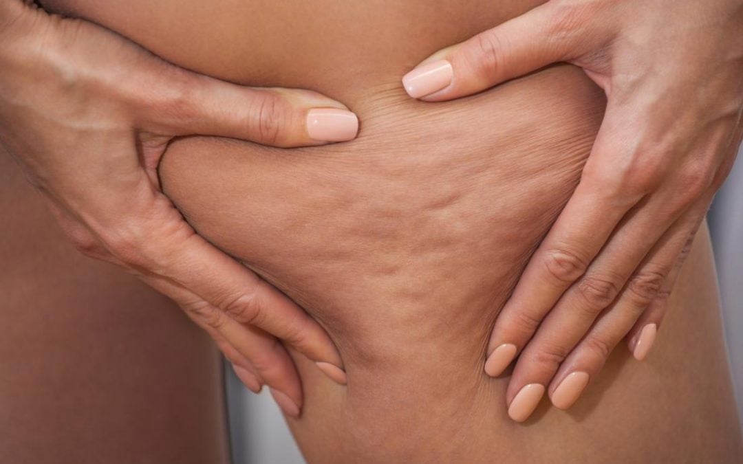 A Possible Cure for that Relentless Cellulite