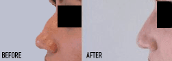 Before and After Non-Surgical Nose Job