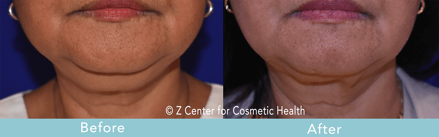 double chin treatment