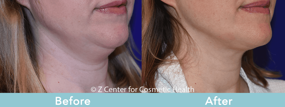 double chin treatment
