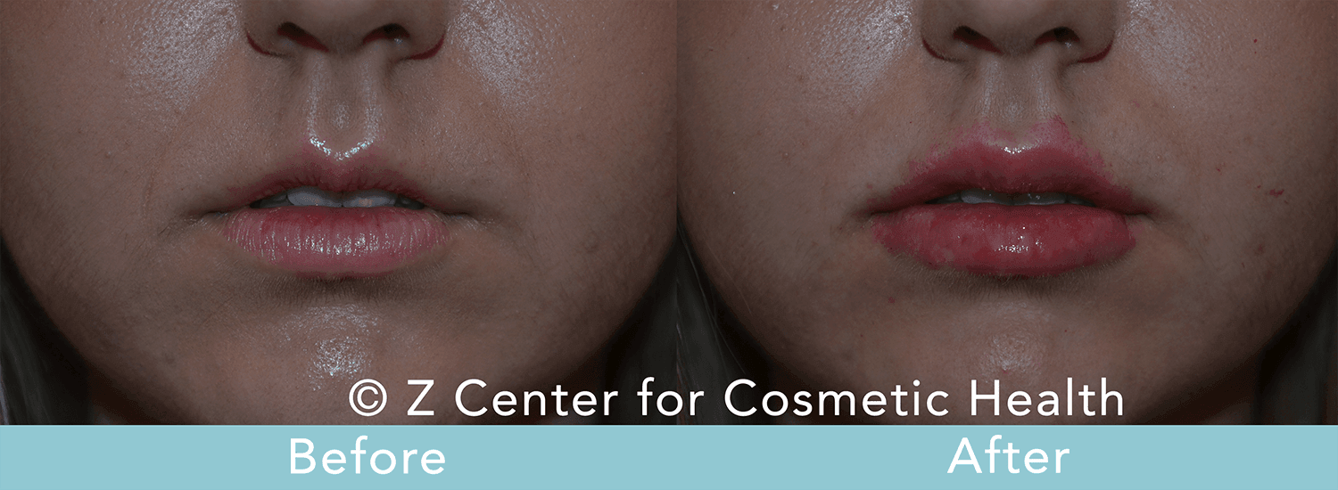 injectable fillers reversible 