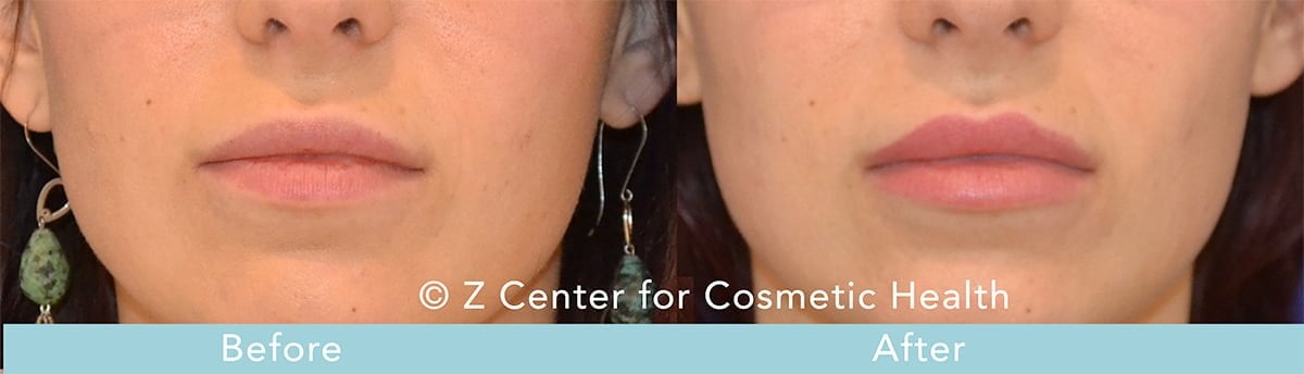 injectable fillers reversible 