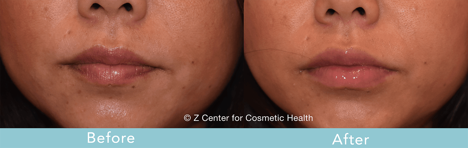 injectable fillers reversible 