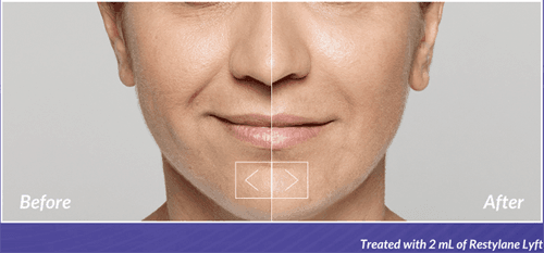 dermal filler