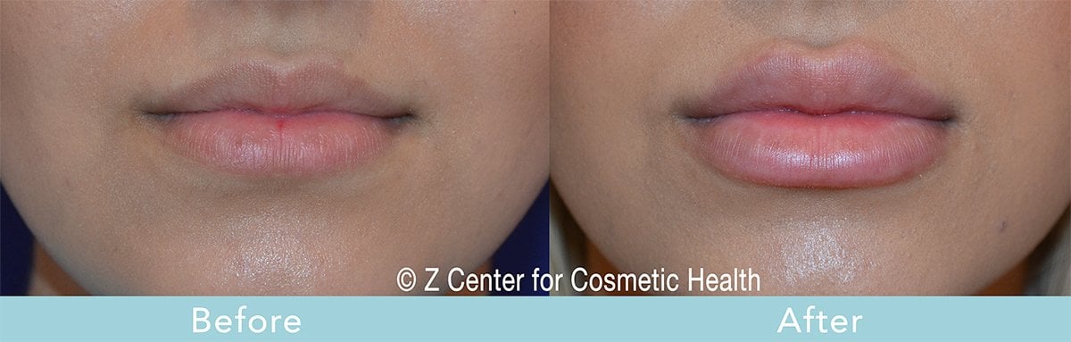 dermal filler