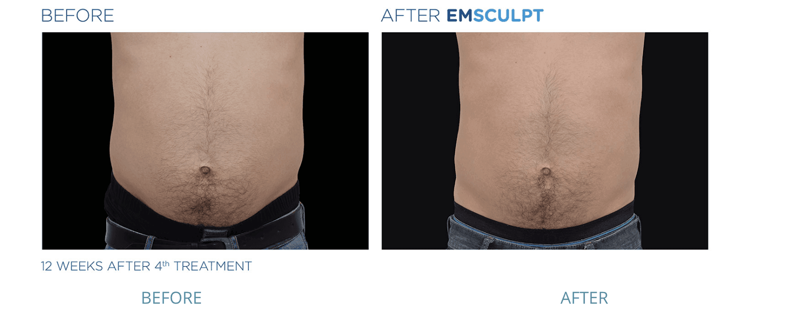 emsculpt