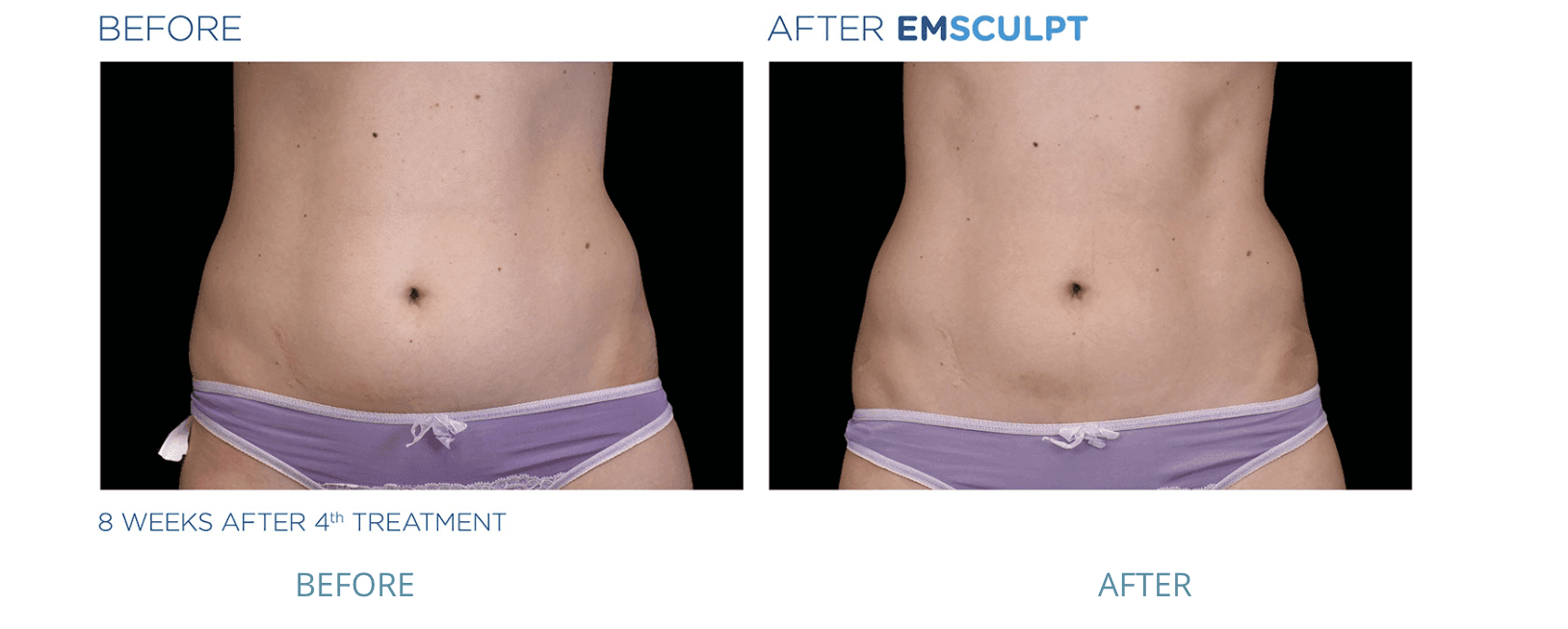 emsculpt