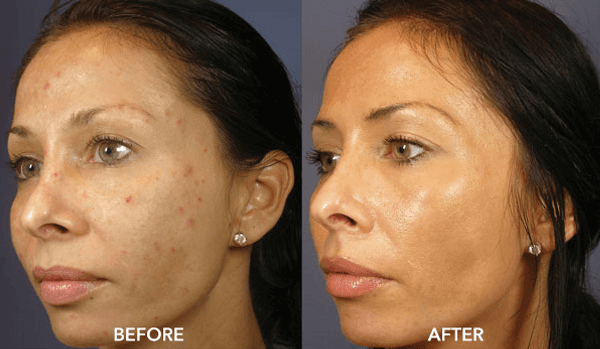 skin peels