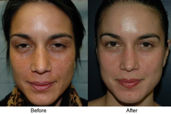 skin peels