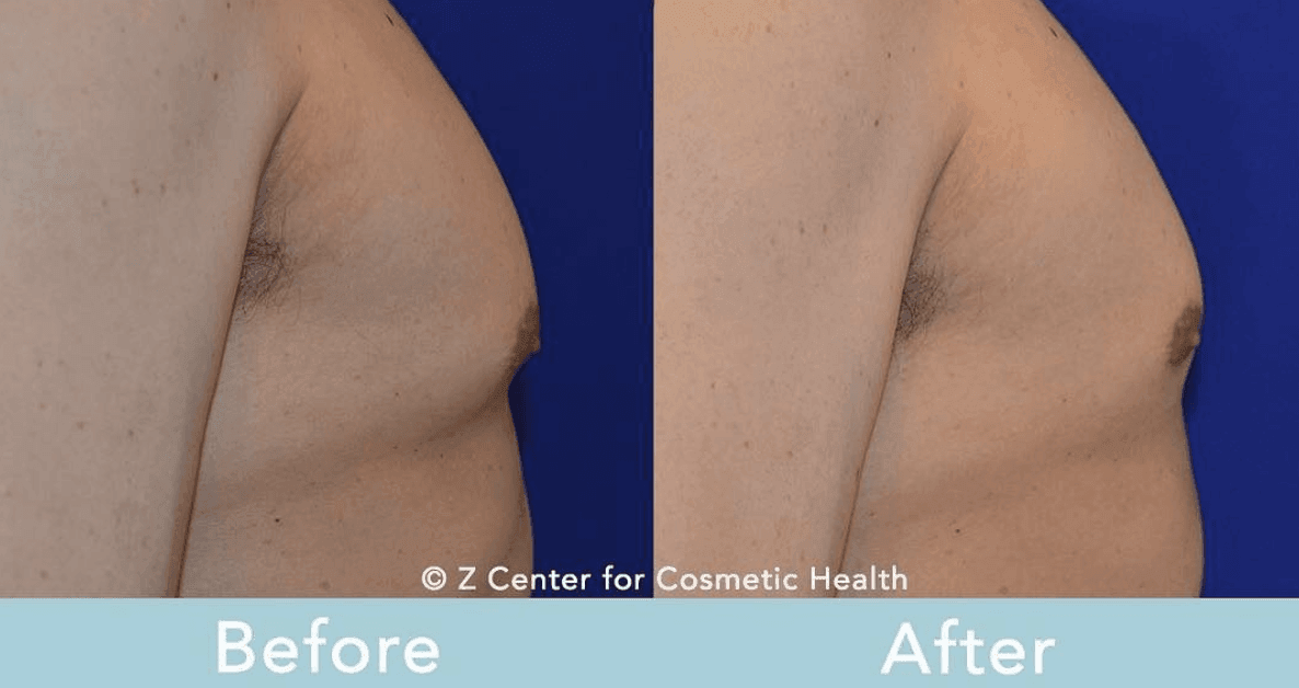 Body Sculpting Treatment