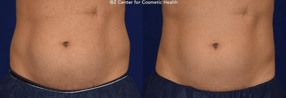 Body Sculpting Treatment