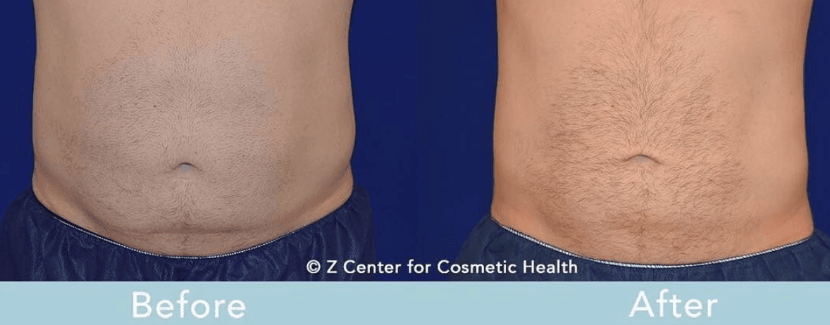 Body Sculpting Treatment