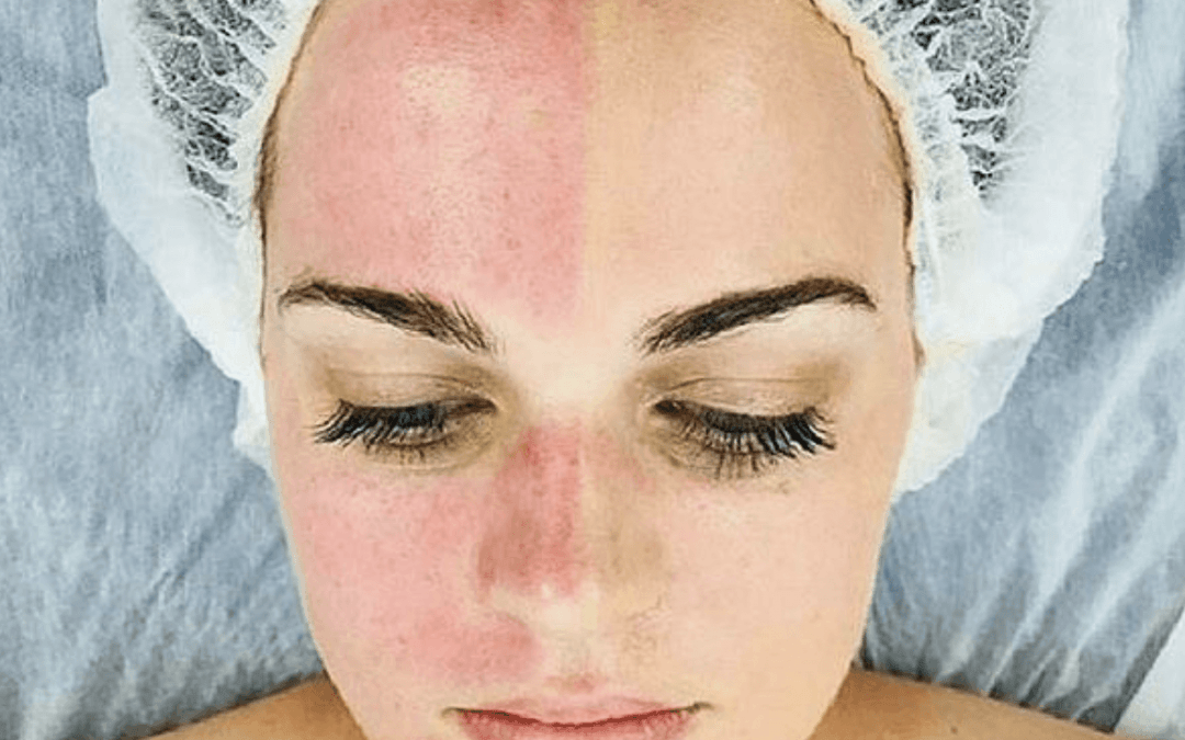 Are Chemical Peels Good for Tightening Skin?