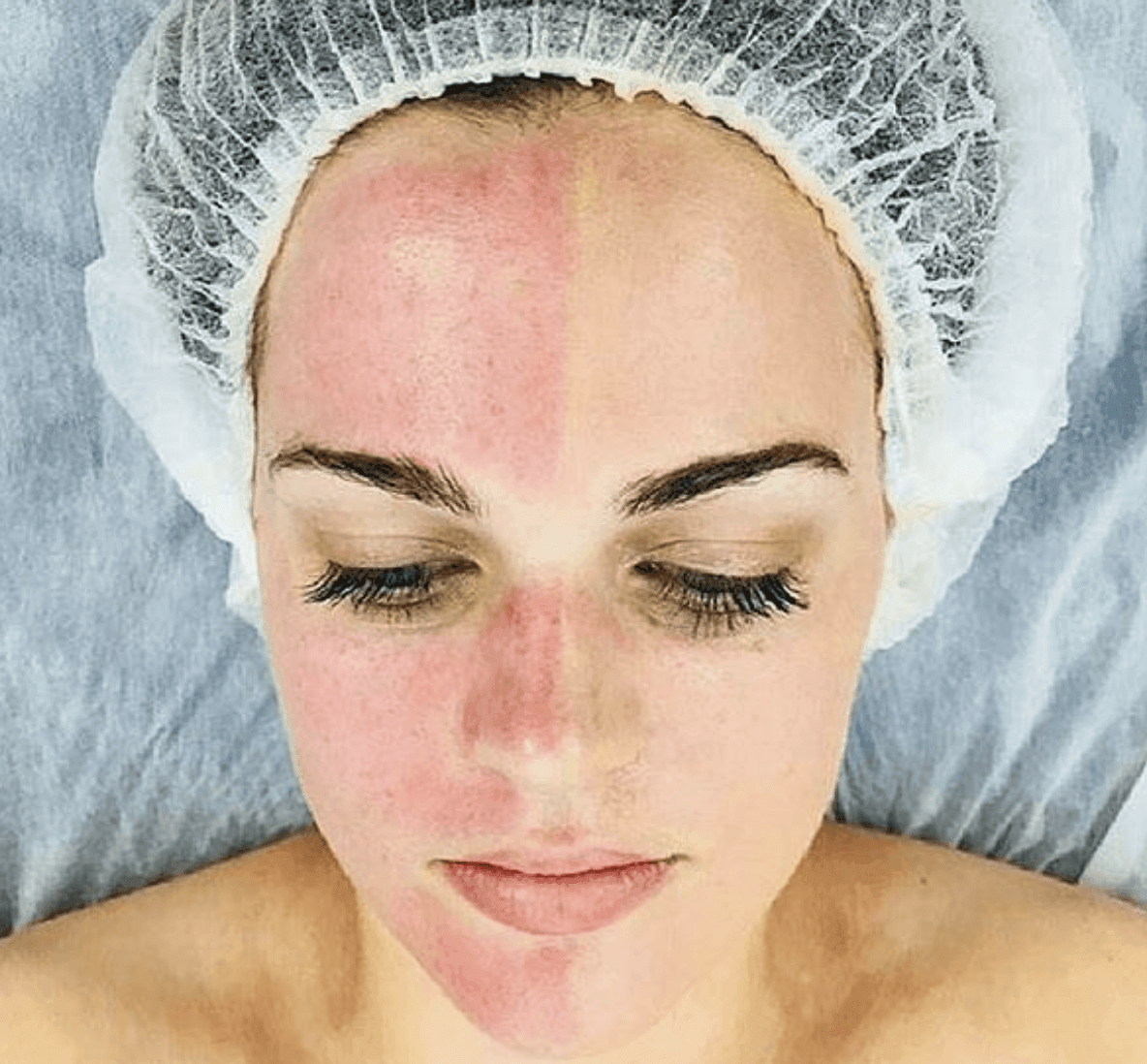 Are-Chemical-Peels-Good-for-Tightening-Skin-