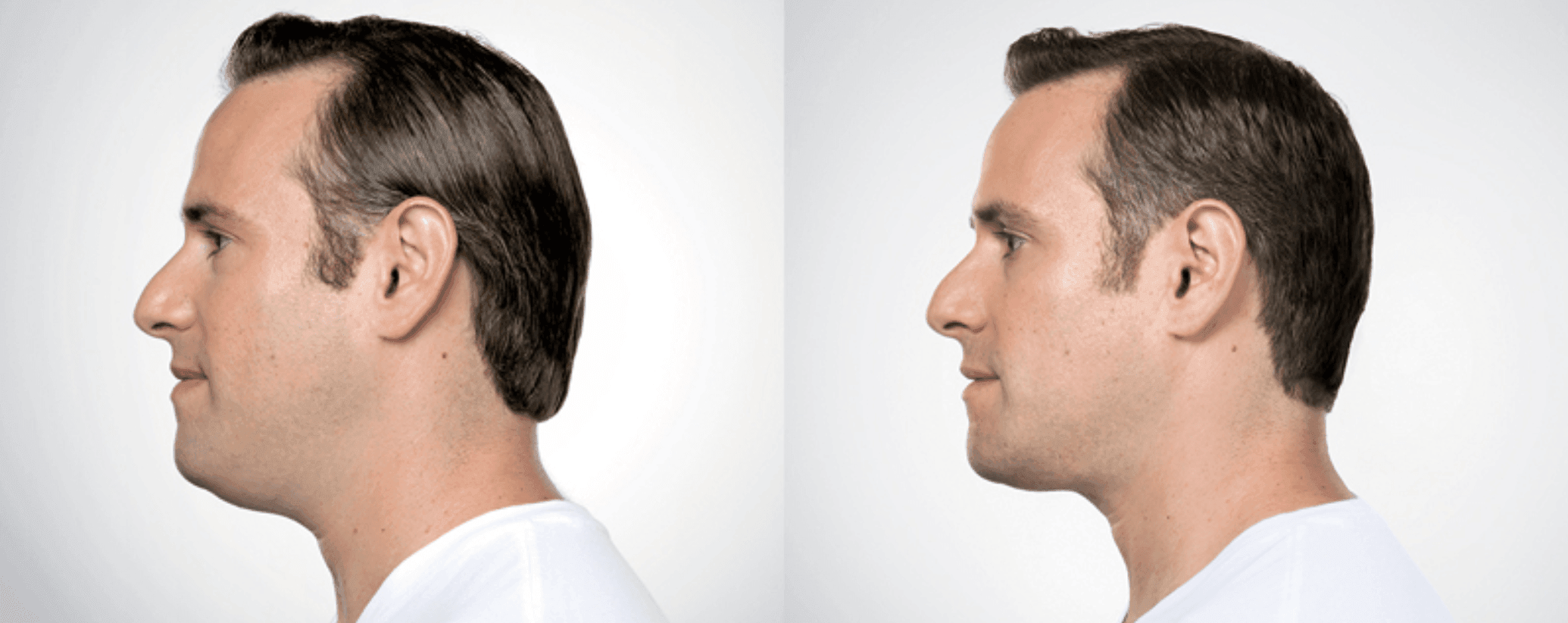 does kybella work for men