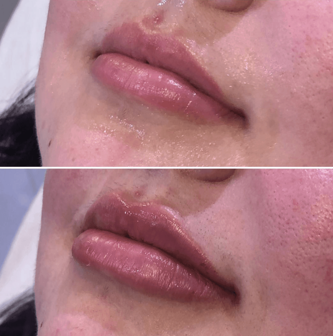 lip fillers
