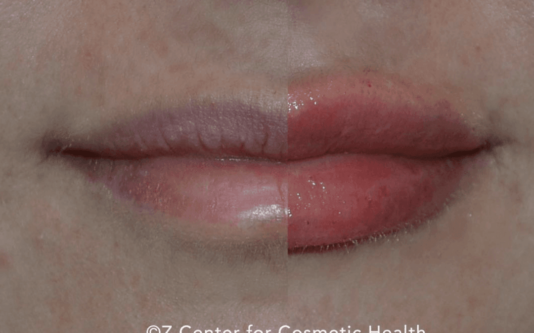 Debunking the Top 7 Lip Filler Myths