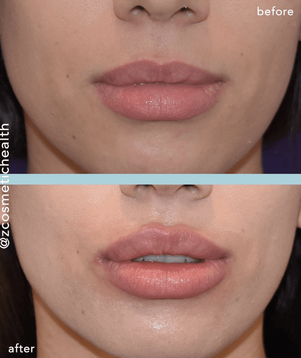 lip fillers