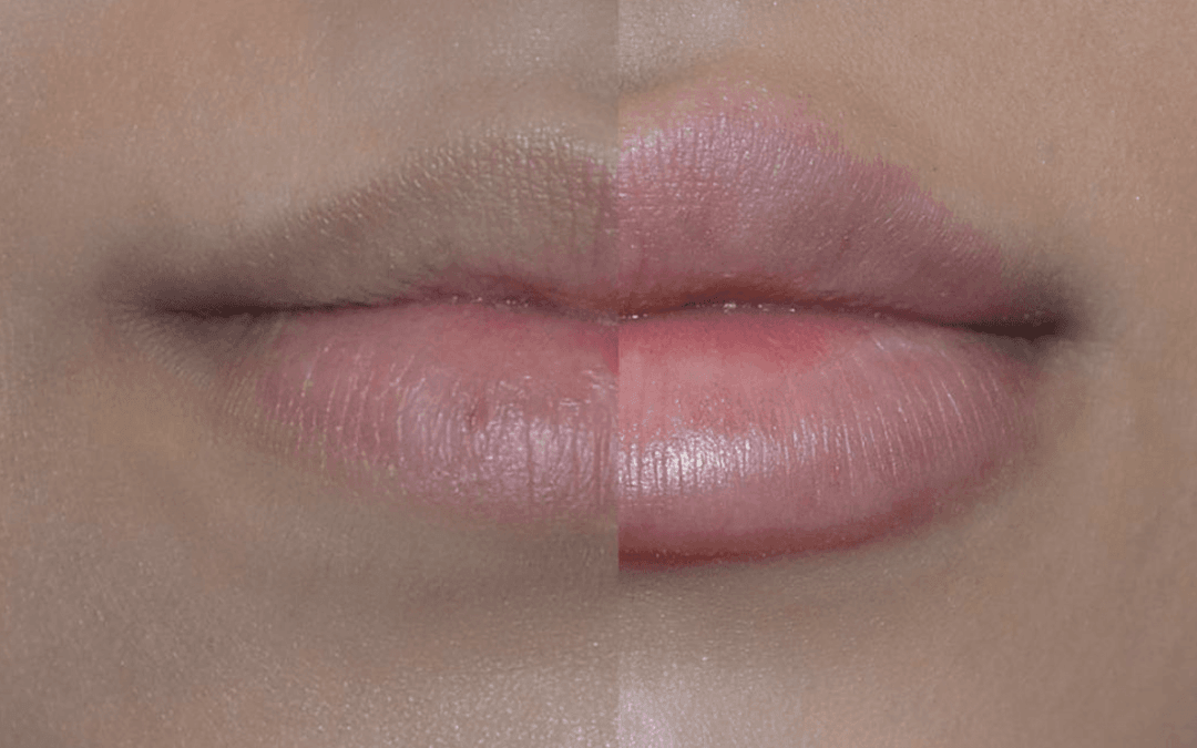 Lip Fillers: What to Expect