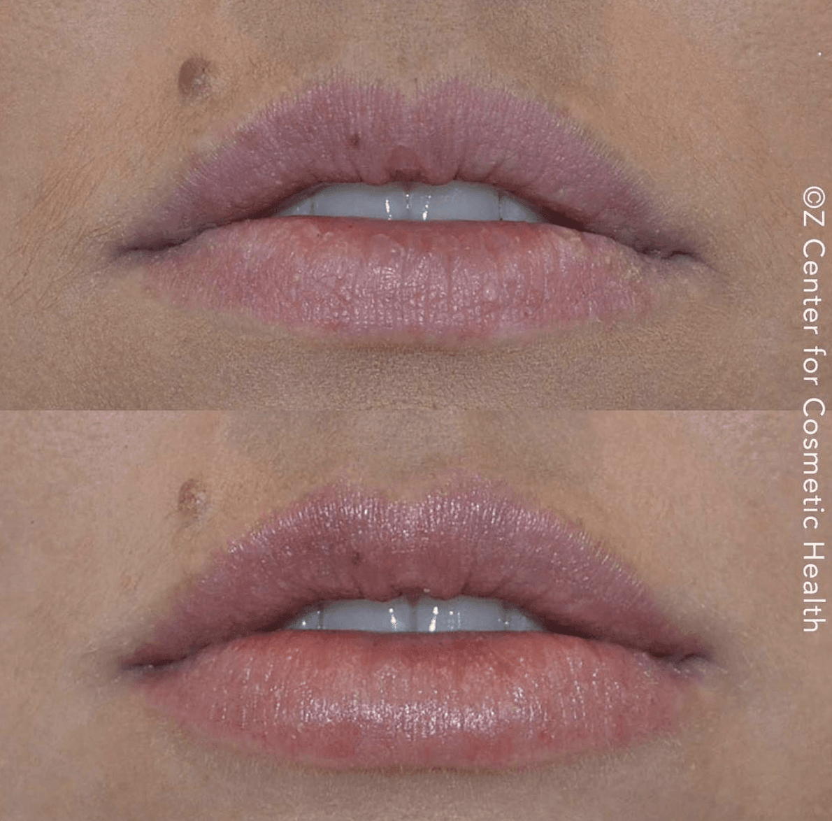 lip fillers