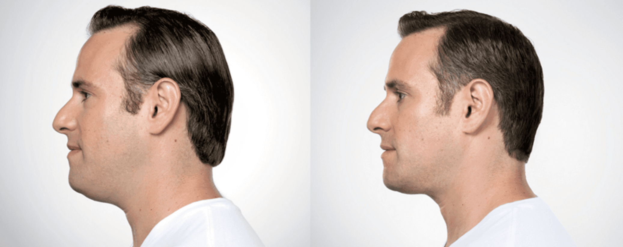 kybella