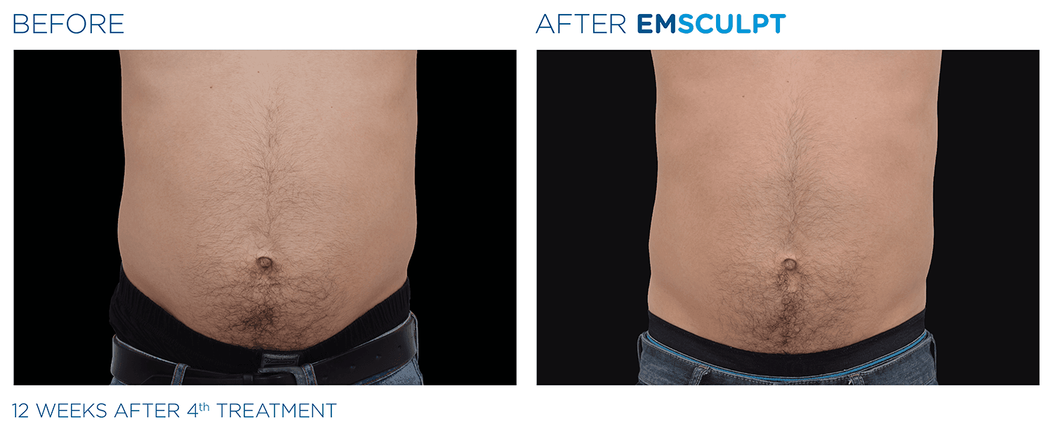 emsculpt and ab conditioning