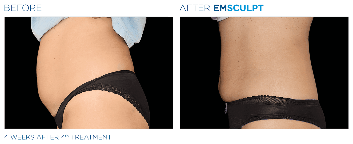emsculpt and ab conditioning