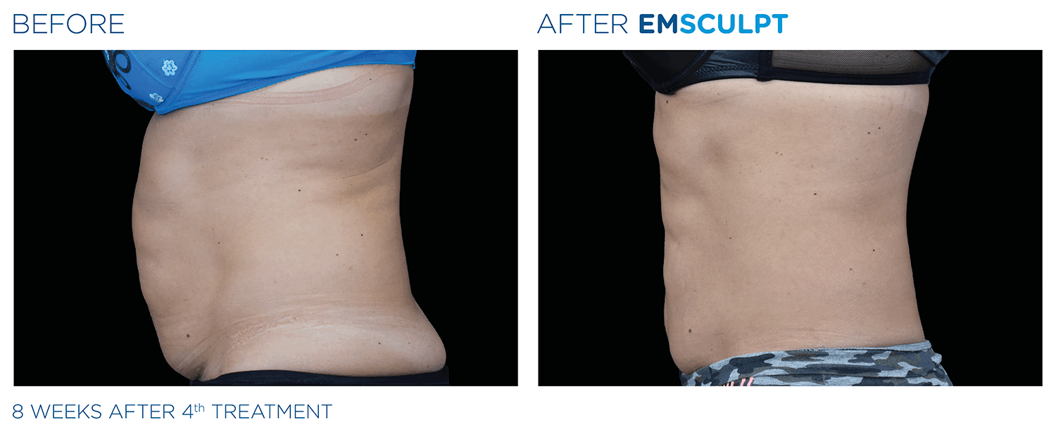 emsculpt and ab conditioning