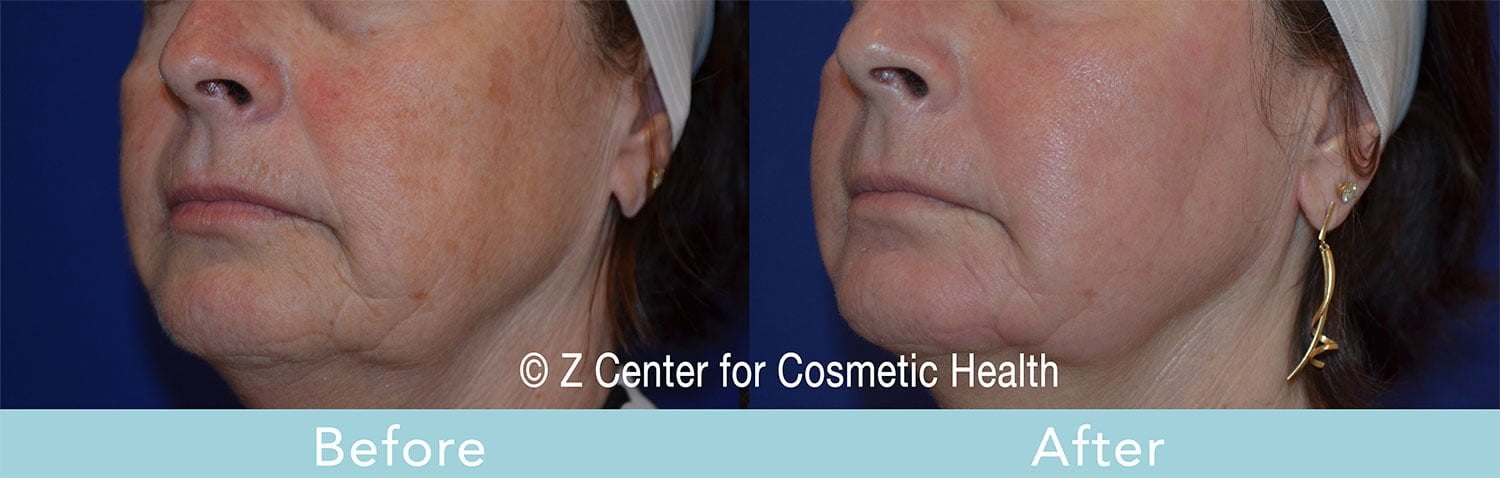 how to treat hyperpigmentation