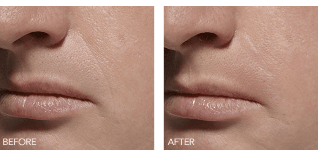 How Do I Get Rid of Smoker Lines?