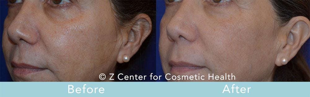 How to Treat Hyperpigmentation