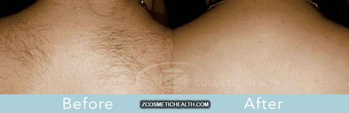 The Do’s and Don’ts of Laser Hair Removal 