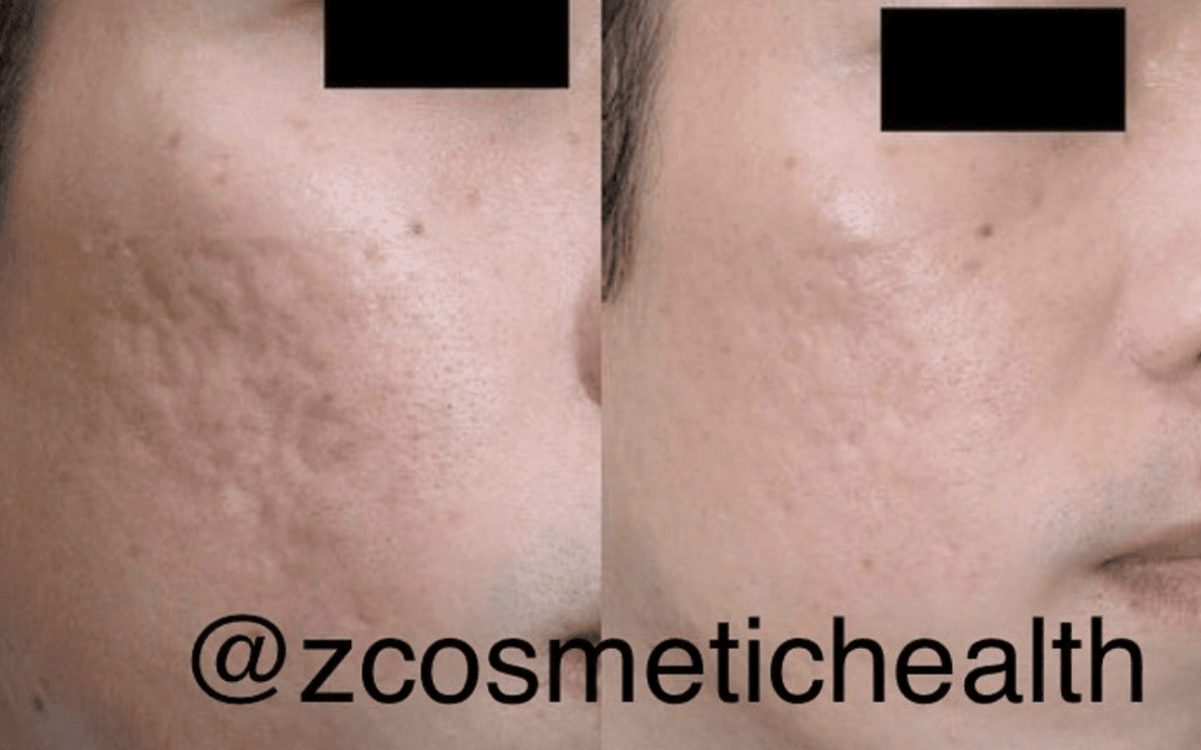 Acne Scar Treatments
