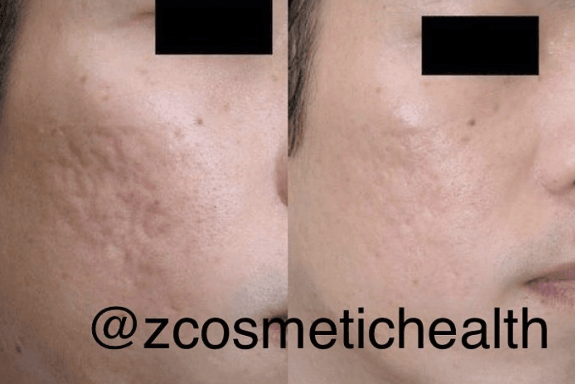 Acne-Scar-Treatments
